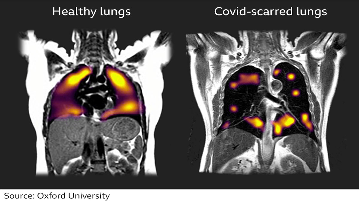 covid-lungs