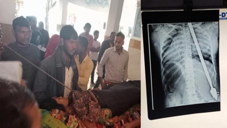 सिवनी: पति ने पत्नी की छाती में घुसेड़ी 5 फुट लंबी राड़, एक्सरे इमेज देख रह जाएंगे हैरान