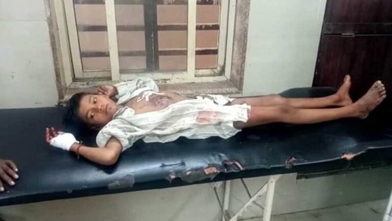 MP BREAKING: मोबाइल की बैटरी फटने से 11 वर्षीय बच्चा बुरी तरह घायल, इलाज जारी