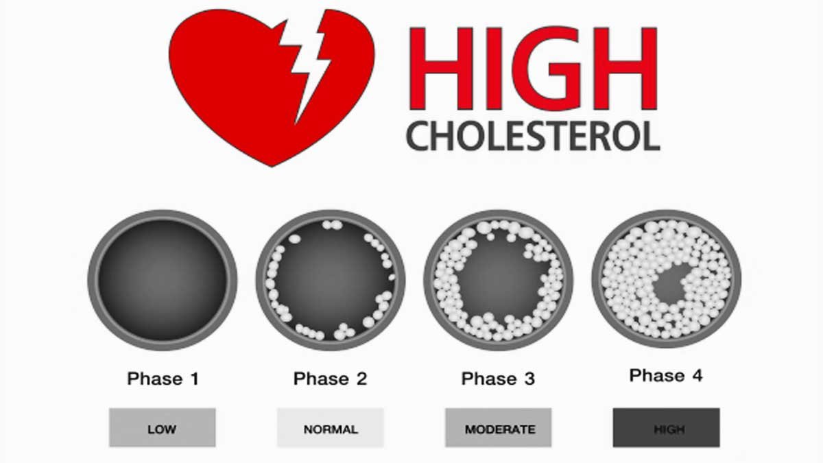 High cholesterol