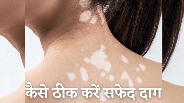 World Vitiligo Day 2023: किन कारणों है से होता है सफेद दाग का रोग होता है, जानें विटिलिगो के बारे