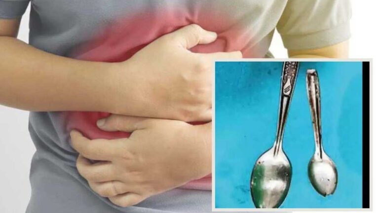 पेट दर्द से पीड़ित 25 साल के युवक के पेट से निकाले गए दो स्टील के चम्मच; लेकिन कैसे निगलें?
