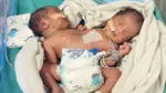 Indore Conjoined Twins Parapagus Dicephalus